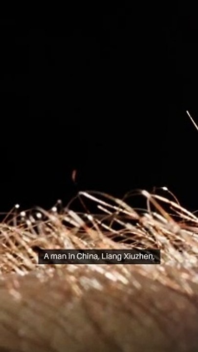 A man in China once had a 4-inch horn growing out of his head