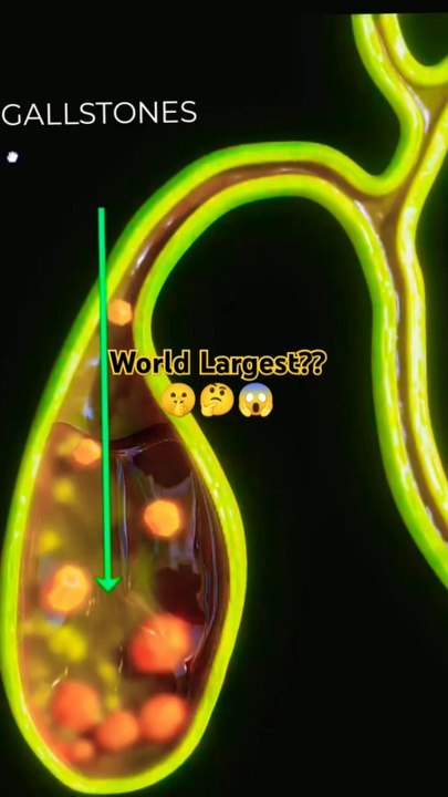Why Gallbladder stones 3D animation shorts?? গলব্লাডার স্টোন 3D অ্যানিমেশন শর্টস पित्ताशय की पथरी 3डी एनिमेशन शॉर्ट्स حصوات المرارة رسوم متحركة ثلاثية الأبعاد 膽囊結石3D動畫短片#viral#dailymotionshorts#Shortsfeed#viralshorts#DrSadia1446