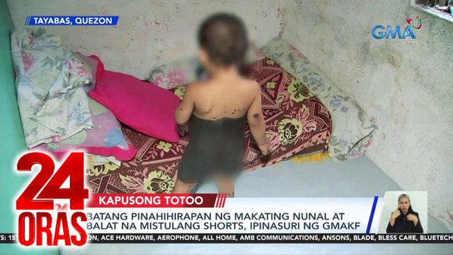 24 Oras Part 2: Ipinasuring malaking nunal at balat ng bata; 772 free wifi sites; itinatayong mega-hemodialysis building ng NKTI, atbp.