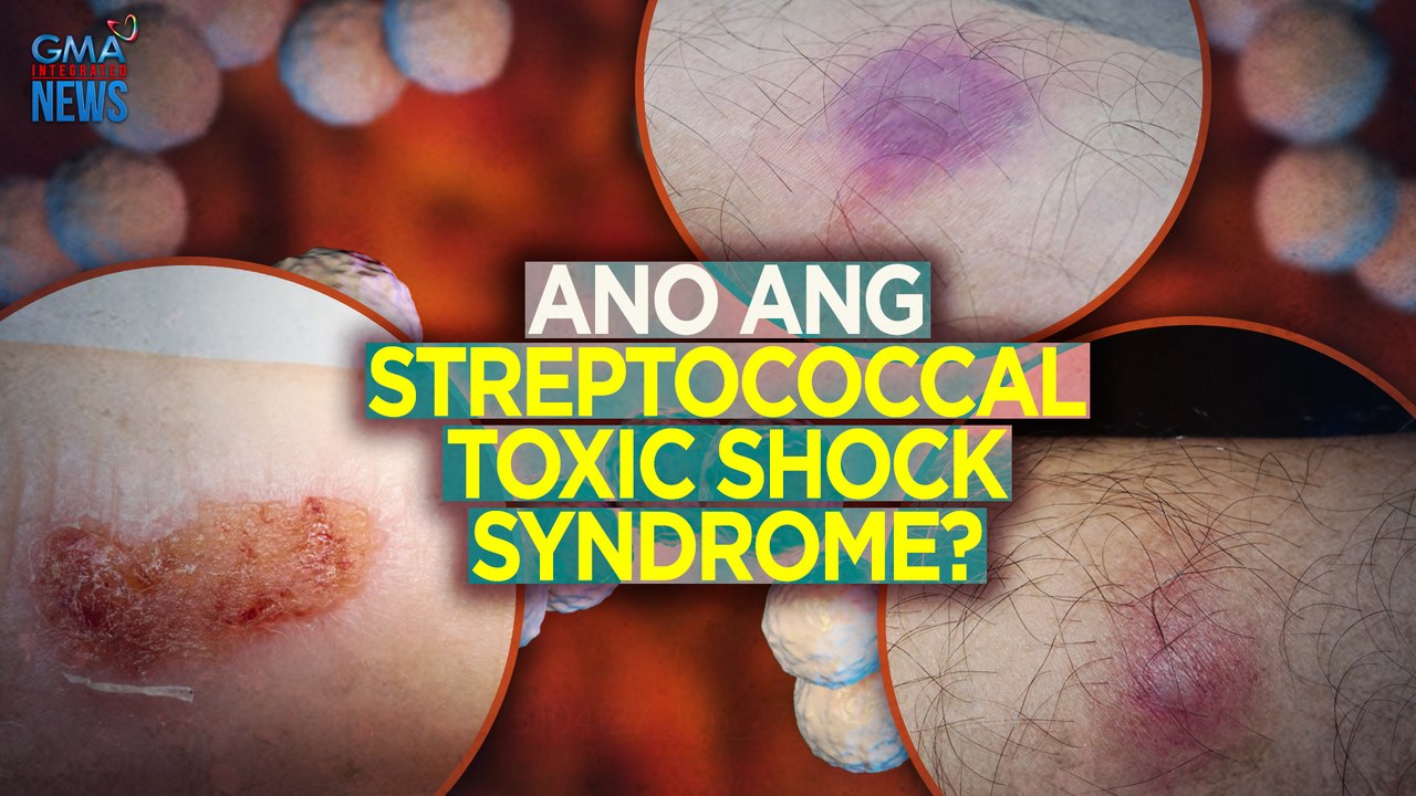 Ano ang Streptococcal Toxic Shock Syndrome? | Need to Know - video ...
