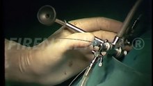 Live kidney stone crushing surgery. Prof Scapicchi. Florence Careggi University clinic - 1983