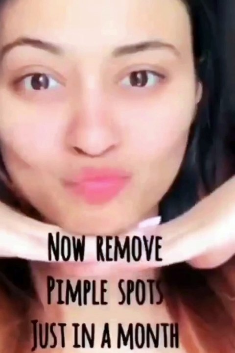 "Banish Pimple Spots in Just 30 Days! ✨ Say Goodbye to Acne Marks #ClearSkin #BeautyHacks"