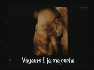 Echographie 3D