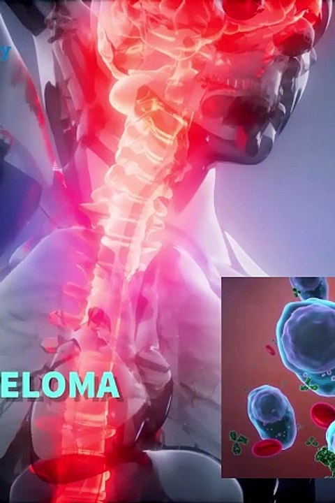 multiple myeloma