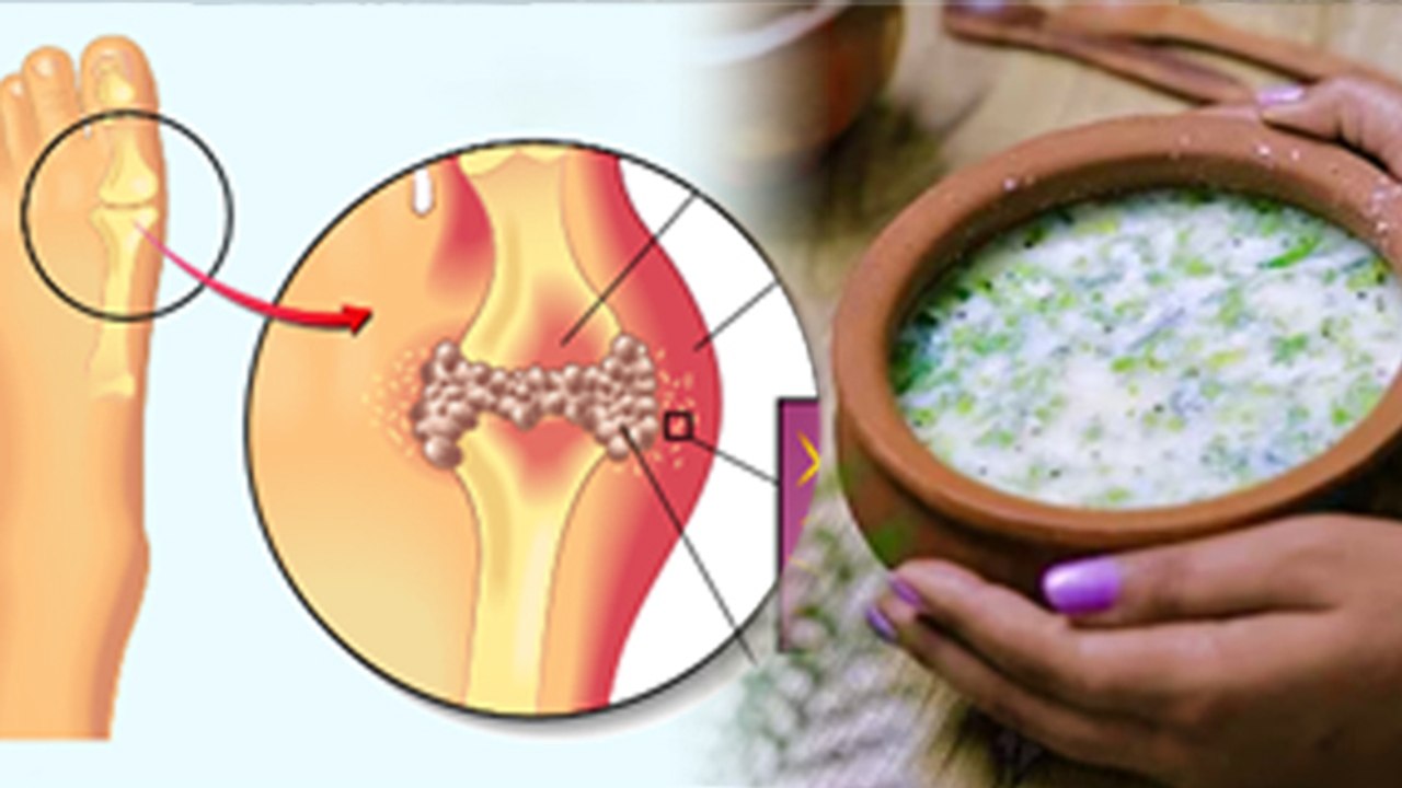 High Uric Acid Me Chach Pina Chahiye ya Nahi,Is Buttermilk Good For High Uric Acid | Boldsky