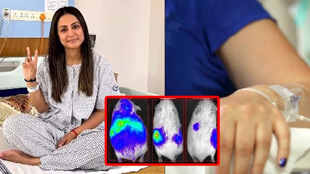 Hina Khan Breast Cancer Chemotherapy:Treatment, Before & After Surgery,Side Effects In Hindi|Boldsky