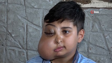 İki farklı yüzü var gibi görünen 14 yaşındaki Enes'in tek isteği iyileşip gülmek