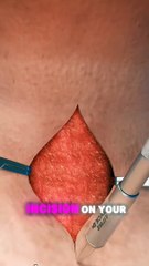 Understanding a Tracheotomy: Procedure and What to Expect 🩺