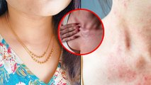 Gold Chain Allergy: Neck Rash Reason, Skin Irritation, Best Cream To Apply|Boldsky