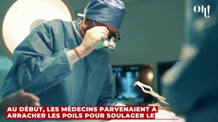 Ce fumeur de 52 ans souffrait d'une croissance rare de poils dans la gorge, voici ce que nous savons