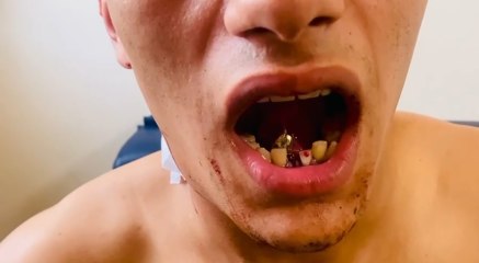 Pendik'te boynundan giren mermi çenesine saplandı