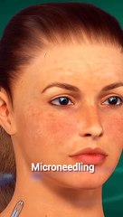 How Microneedling is done?