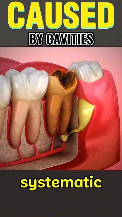 Cavity risks  Tooth decay dangers Oral health issues मौखिक स्वास्थ्य संबंधी समस्याएं قضايا صحة الفم Dental care tips Cavity prevention  Healthy smile