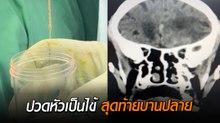 หมอสมองออกมาเตือน เป็นไซนัสอักเสบต้องระวัง อาจบานปลายแบบนี้