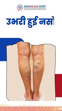 उभरी हुई नसों से पाएं छुटकारा!अब पैरों में नसों का दर्द आपके जीवन में नहीं बनेगा परेशानी!क्योंकि, वैरिकोज वेन्स का इलाज हुआ और भी आसान!लेज़र ट्रीटमेंट सें पाएं बेहतर परिणाम ! बिना किसी चीरे, दाग, और दर्द