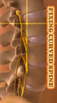 Spinal cord injury 3D animation shorts रीढ़ की हड्डी की चोट 3डी एनिमेशन शॉर्ट्स স্পাইনাল কর্ড ইনজুরি 3D অ্যানিমেশন শর্টস إصابة الحبل الشوكي شورت رسوم متحركة ثلاثي الأبعاد 1. Spinal Cord Surgery Explained 2. Spine Surgery Animation 3. Spinal Injury Tr