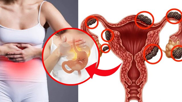 Endometriosis Stage 1 Symptoms, Pain, Body Effect Explained In Hindi | Boldsky