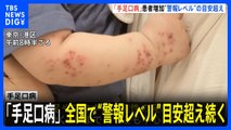 【速報】「手足口病」全国で“警報レベル”目安超え続く　14週連続増加　1医療機関あたり8.45人｜TBS NEWS DIG