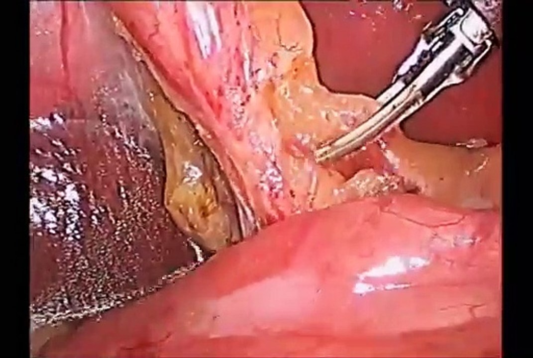 Laparoscopic Cholecystectomy by Meltzer Knot and harmonic Scalpel HD