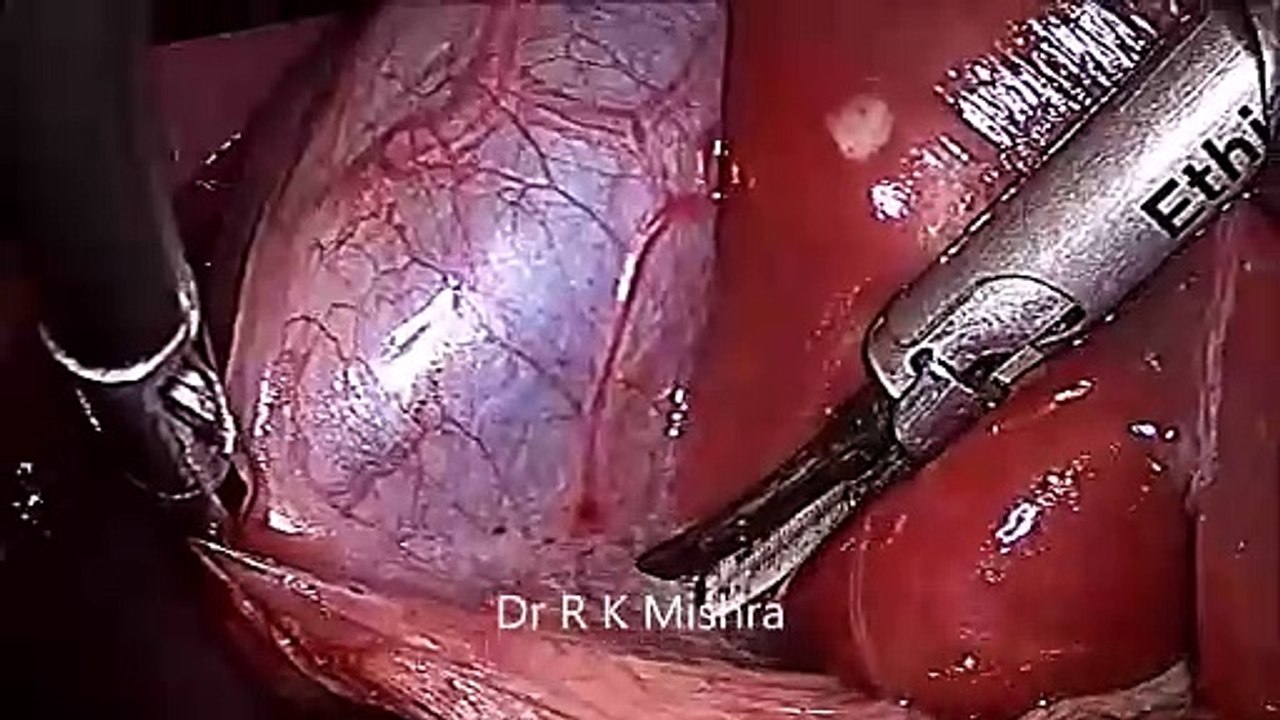 Laparoscopic Cholecystectomy for 5 Year Old Child