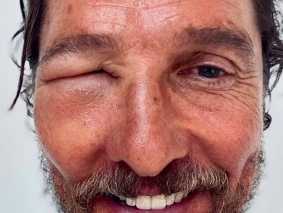 Matthew mcconaughey postet selfie von bienenstich am auge