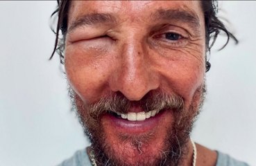 Matthew McConaughey sufre una picadura de abeja que le dejó la cara completamente hinchada