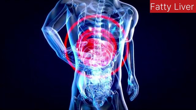 Fatty Liver Home Remedies: Fatty Liver Treatment | Fatty Liver Symptoms | Fatty Liver Diet