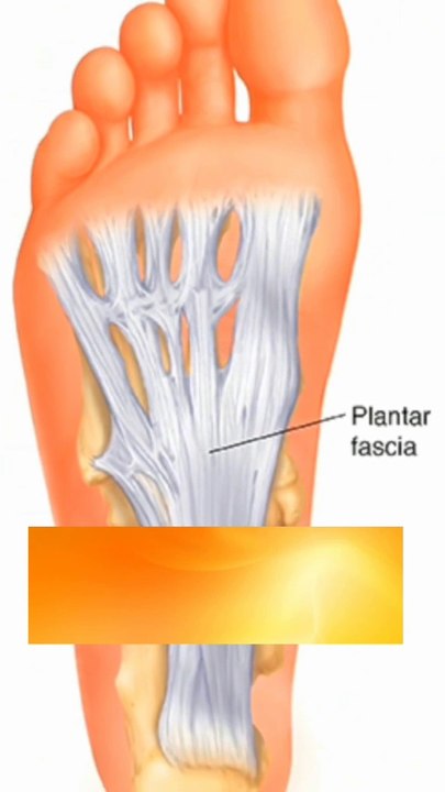 Heel Spur shorts  हील स्पर शॉर्ट्स अस्थि स्कंध شورت كعب سبي حفز العظام  Heel Pain Relief Foot Solutions Heel Surgery Foot Relief #HeelSpur #PlantarFasciitis #FootPain #HeelPain #BoneSpur #FootCare #Orthotics #FootHealth #PainRelief #HeelSpurTreatment #F