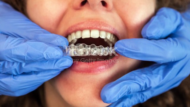 How to Get the Best Results from Invisalign Treatment | Orthodontist | Grant Orthodontics