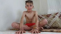 Deri hastalığı hayatını kâbusa çevirdi! Arkadaşlarının dalga geçtiği deri hastalığından kurtulmak istiyor