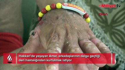 Amar'ın tek isteği iyileşmek! 'Günde 5 kez kıyafetlerimi değiştiriyorum'