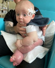 Tot with "uncontrollably" growing foot takes first steps against the odds