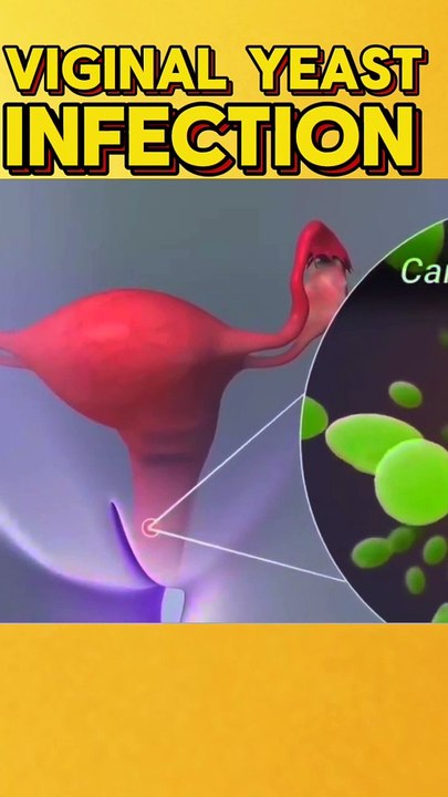 Yeast infection in private part प्राइवेट पार्ट में यीस्ट इन्फेक्शन عدوى ...