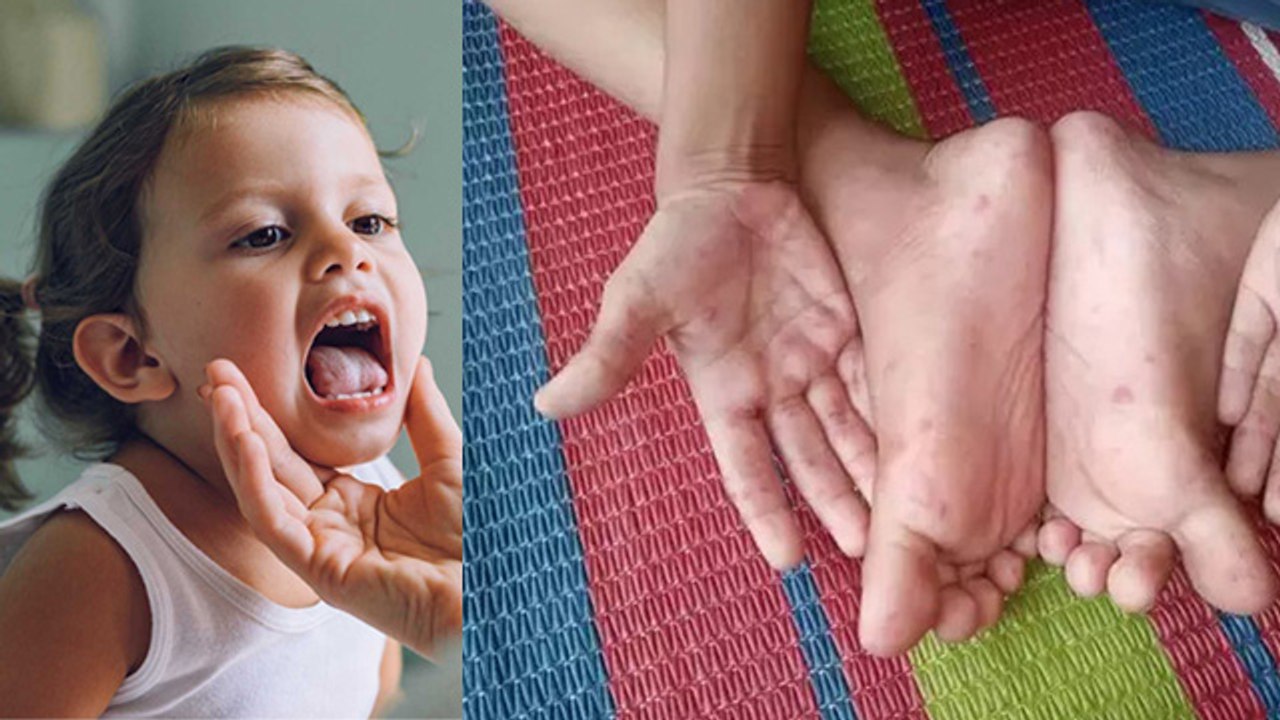 HFMD Disease In Delhi, Causes, Symptoms, Treatment In Hindi|Boldsky