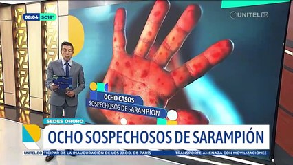 Ocho casos sospechosos de sarampión en Oruro se encuentran estables, Sedes descarta caso autóctono
