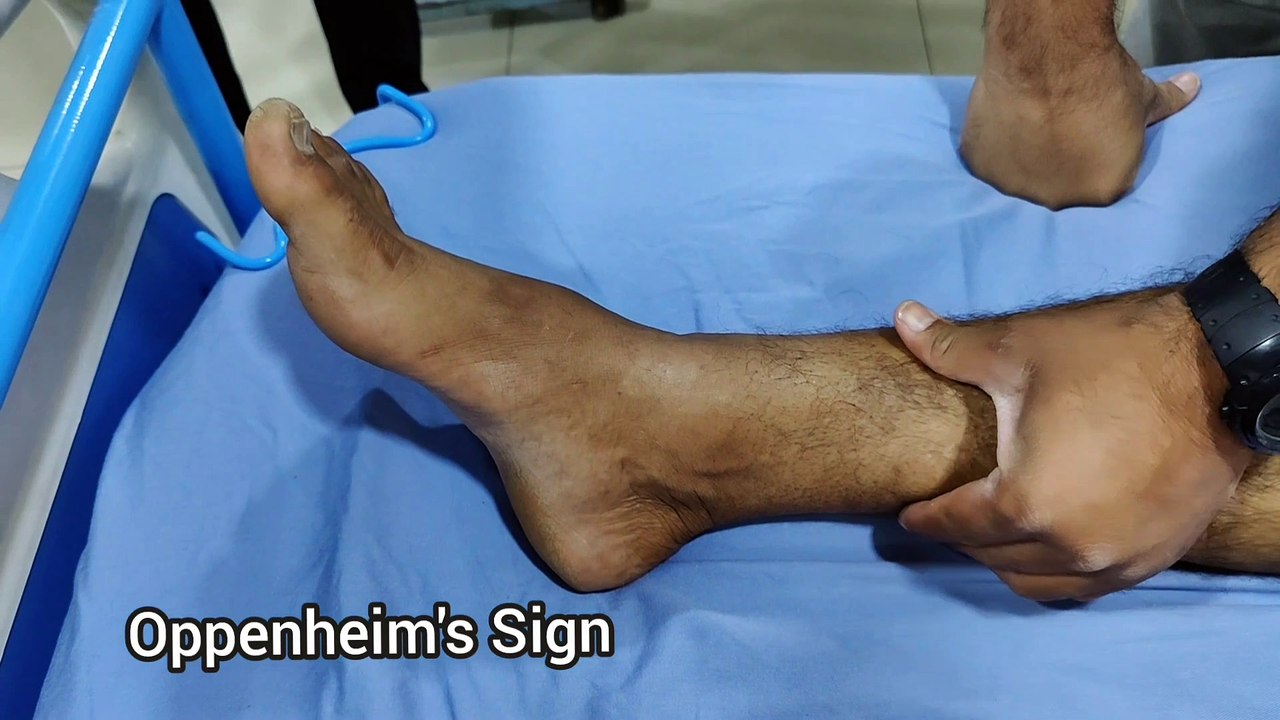 Hyperreflexia: How to Examine Hyperreflexia?