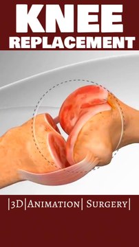 यह रहे हैशटैग और खोजशब्द Knee replacement 3D video Orthopedic surgery animation |#viral #shorts #3danimationsurgery #shortsfeeds