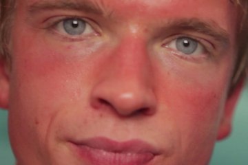 Scottature solari: come curare le ustioni d'estate