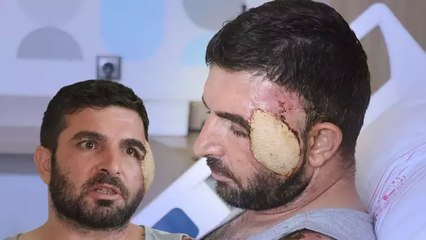 Çocuklarını kurtarmak için otomobilinin önüne atladı; yaralanan yüzüne bacağından doku nakli yapıldı