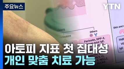 아토피 파악 지표 첫 집대성...개인 맞춤 치료 가능 / YTN