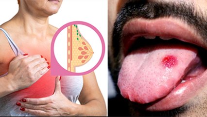 Breast Cancer To Lung Cancer Young Age में किसका High Risk, Cancer In Young Age Reason