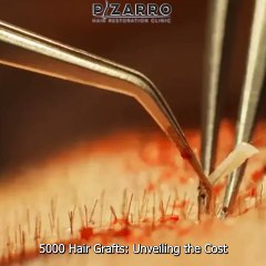 5000 Hair Grafts: Unveiling the Cost