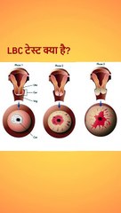 LBC test in hindi | बच्चेदानी के मुंह के कैंसर को पता करने के लिए सबसे अच्छी जांच |