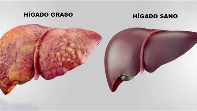 bd-claves-para-prevenir-higado-graso-230724