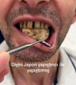 Kırılan Dişleri Düşmesin Diye Japon Yapıştırıcısıyla Yapıştırdı