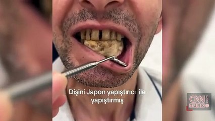 Video Haber | Kendinizin doktoru olmayın! Dişlerini Japon yapıştırıcısı sürdü!