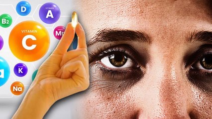 Download Video: Which Vitamin Deficiency Causes Dark Circles, Kis Vitamin Ki Kami Se Dark Circle Hote Hain | Boldsky