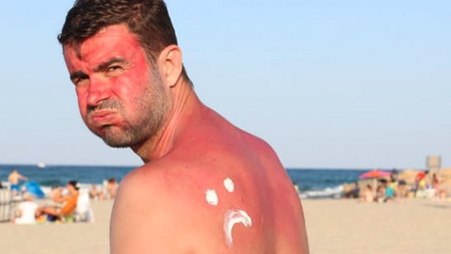 Cómo Tratar Las Quemaduras Solares Para Un Alivio Inmediato