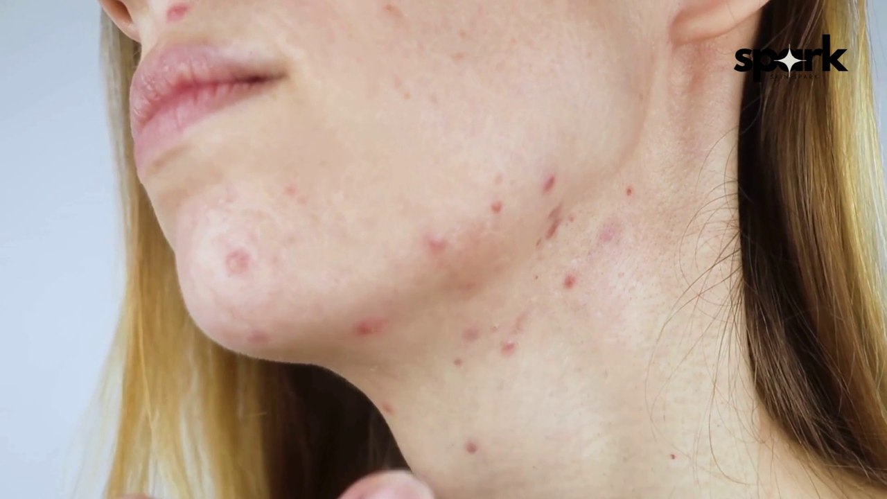 How to remove acne, pimples and blackheads from face and its causes.  Skincare tips for glowing skin