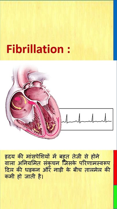 Atrial Fibrillation in hindi, एट्रिअल फिब्रिलेशन, एट्रिअल फिब्रिलेशन क्या है,